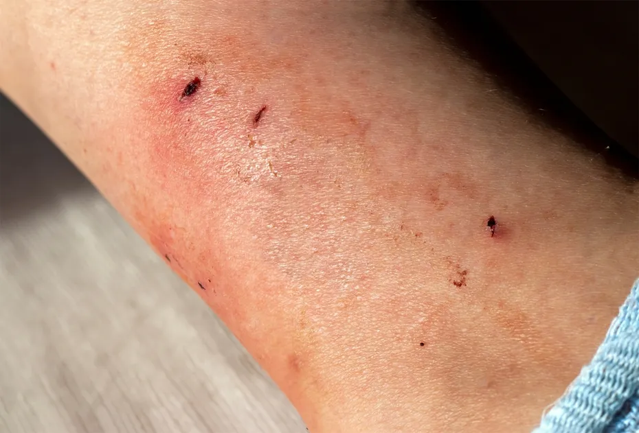 cat bite marks on an arm