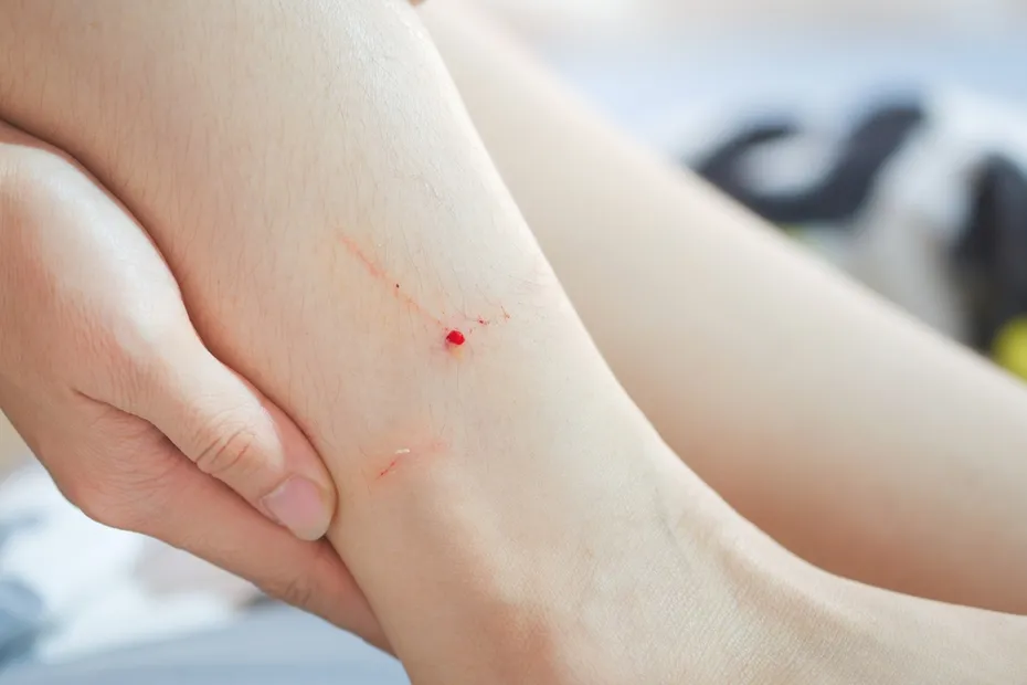 ankle wound caused by a cat bite
